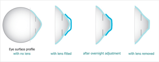 What Are Ortho K Lenses